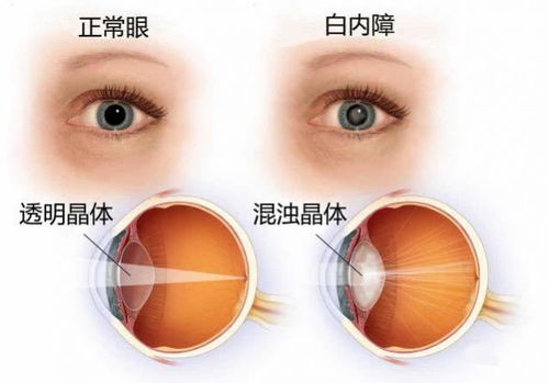 深入了解急性角膜炎，症状、诊断与治疗