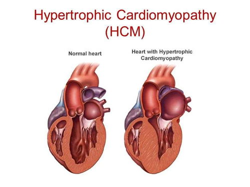 深入了解肥厚性心肌病，从症状到治疗