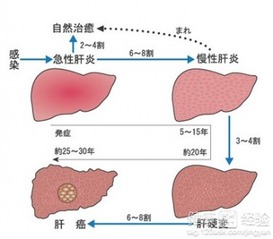 揭秘急性黄疸肝炎，症状、成因与防治策略