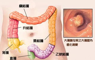 揭秘便血，原因、诊断与治疗