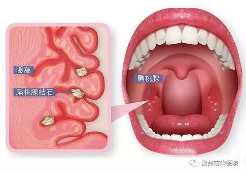 喉咙异物感，原因、诊断与应对策略